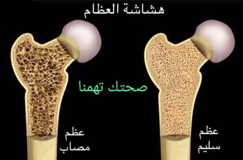 هشاشة العظام